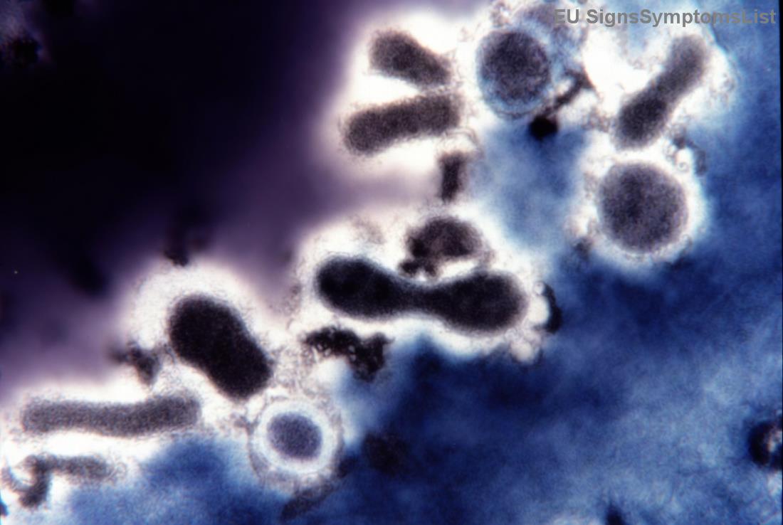 Indolens Non-Hodgkin limfóma kezelési lehetőségek illusztrációja