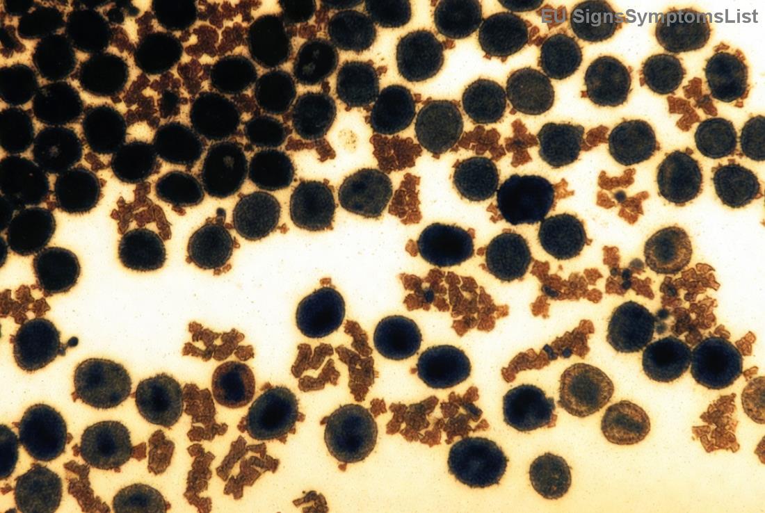 Aktivni život nakon limfoma Hodžkina