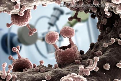 Излекувим ли е стадиум 3 рак на белите дробове с комбинирана терапия? Шансове за пълно излекуване и модерни методи