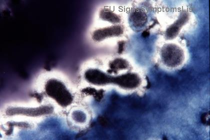 Излечим ли е ракът на гърдата на стадия 1 и 2? 99% успех с ранно лечение!