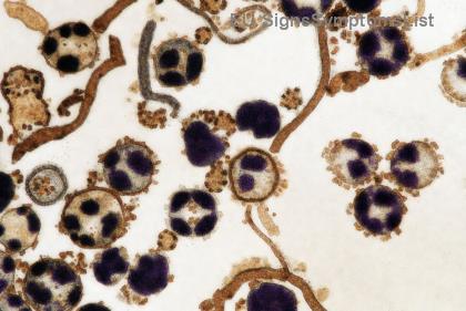 Je glioblastóm vysokého stupňa vyliečiteľný? Najnovšie nádeje a efektívne stratégie