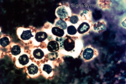 A është Kanceri i Qafës së Mitrës në Fazë të Hershme plotësisht i Shërueshëm? Shpresa të Reja për Shërim të Plotë!