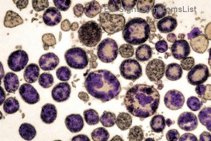 Je Hodgkinův lymfom v raných stádiích vyléčitelný? Naděje s úspěšností až 95 % ⭐