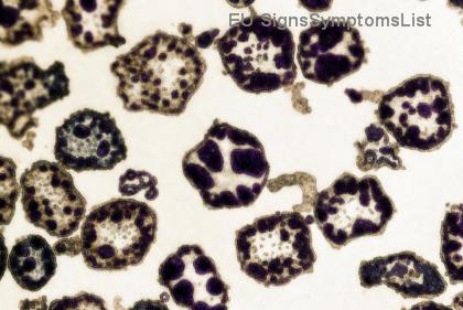 Péče o pacienta s lymfomem: Tajemství vyvážené výživy, odpočinku a emoční podpory