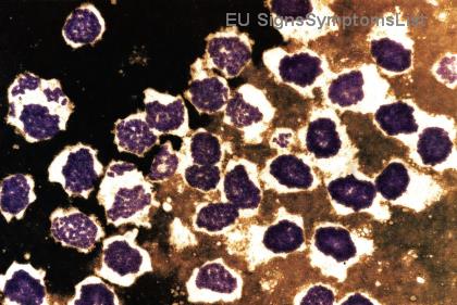 A Hodgkin-limfóma korai stádiumban gyógyítható? 90% feletti sikerarány a legújabb kezelésekkel!